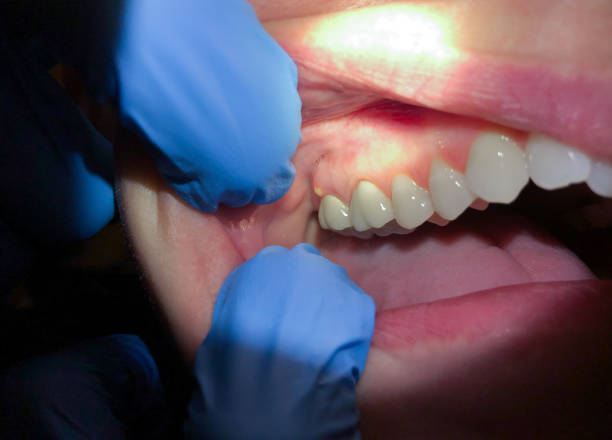Best Chipped Tooth Repair Near Me  in Matoaca, VA